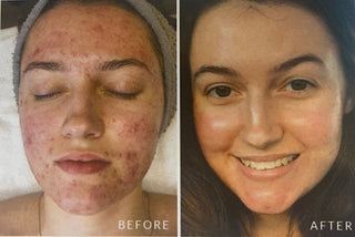 Face Reality Acne Program - Get Clear Skin Once and for All.